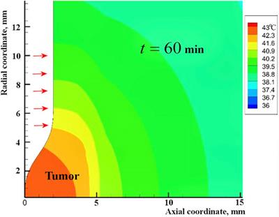 Laser-Induced Thermal Treatment of Superficial Human Tumors: An Advanced Heating Strategy and Non-Arrhenius Law for Living Tissues